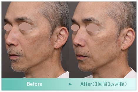 症例写真 Before After 1