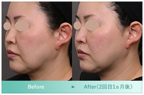 症例写真 Before After 2
