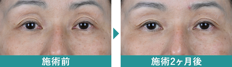 デンシティ 症例写真Before After