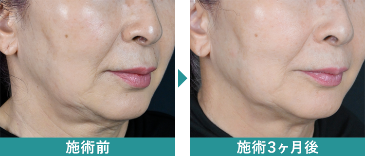 デンシティ 症例写真Before After