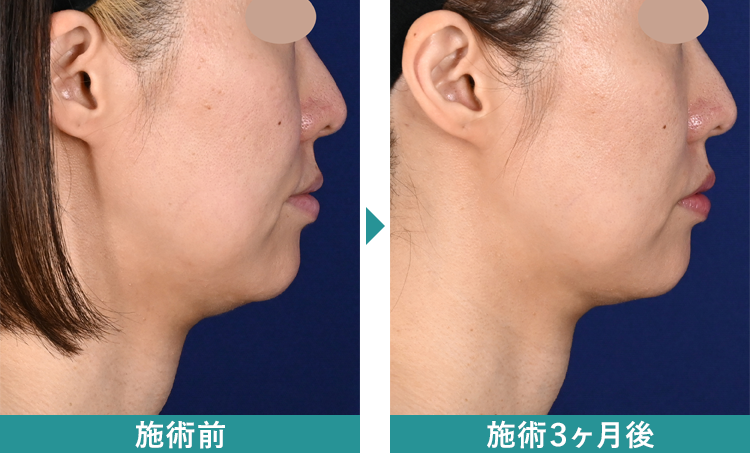 デンシティ 症例写真Before After