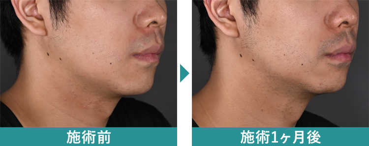 デンシティ 症例写真Before After