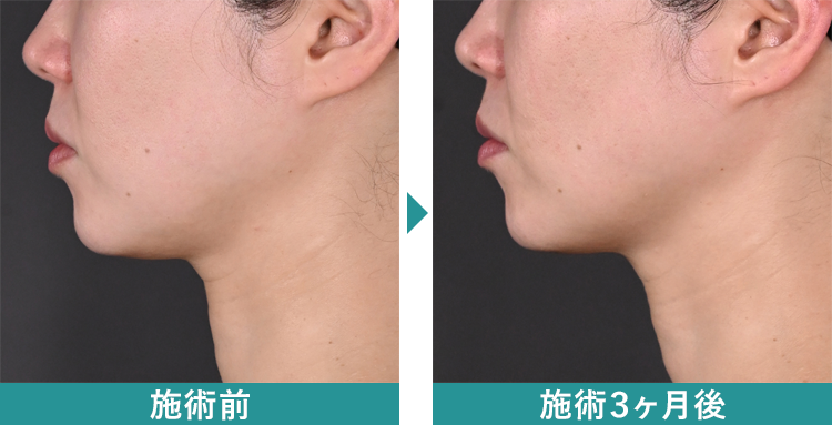 デンシティ 症例写真Before After