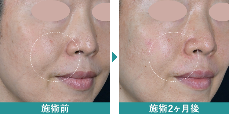 デンシティ 症例写真Before After