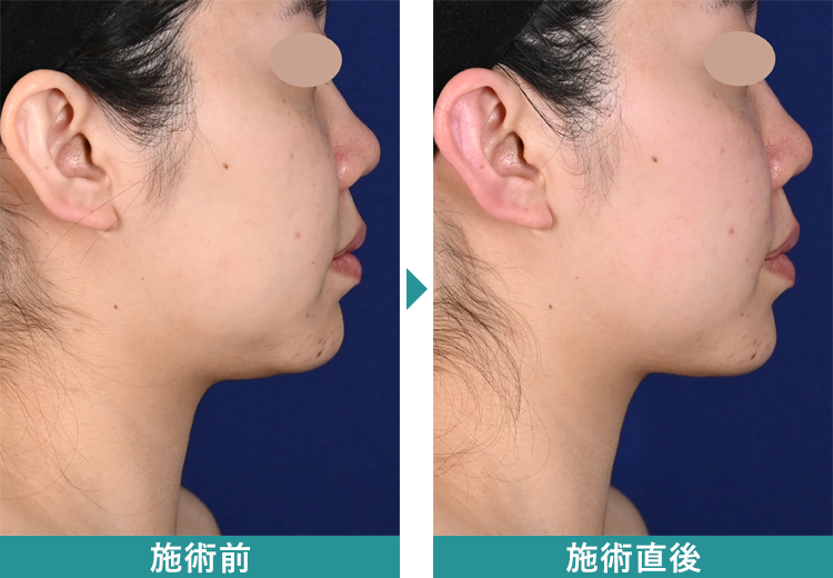 デンシティ 症例写真Before After