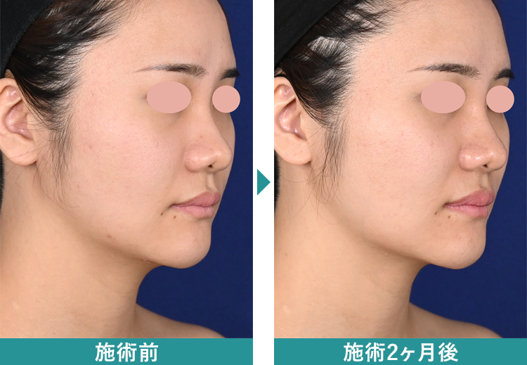 デンシティ 症例写真Before After