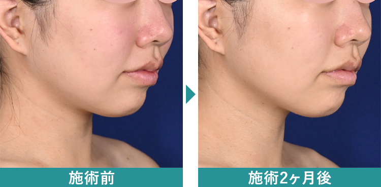 デンシティ 症例写真Before After