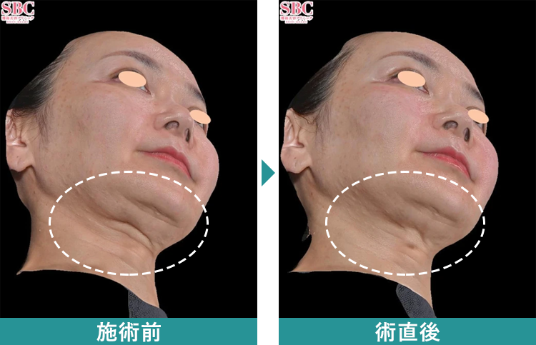 デンシティ 症例写真Before After