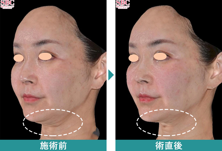 デンシティ 症例写真Before After