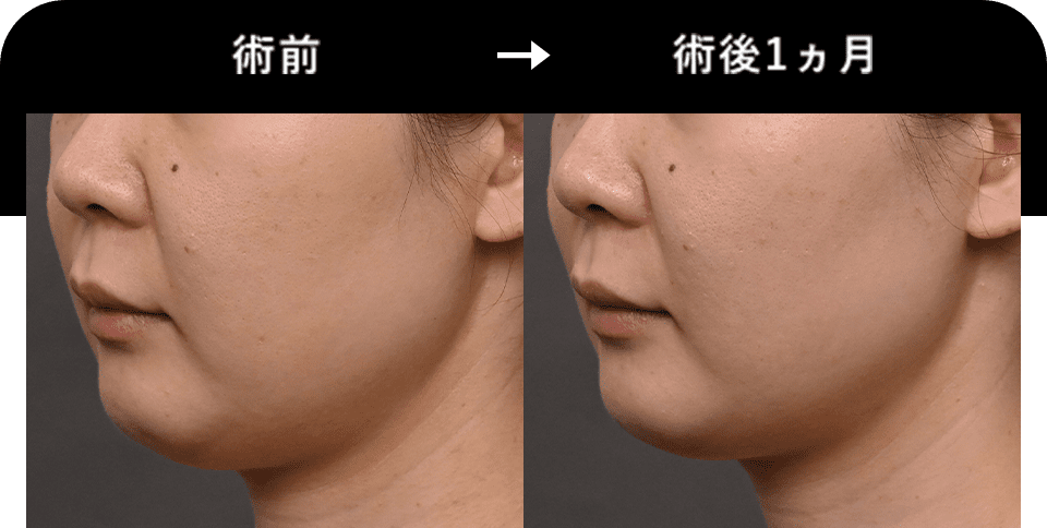 Before After