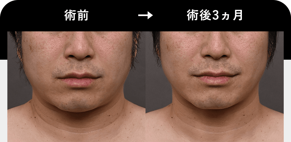 Before After