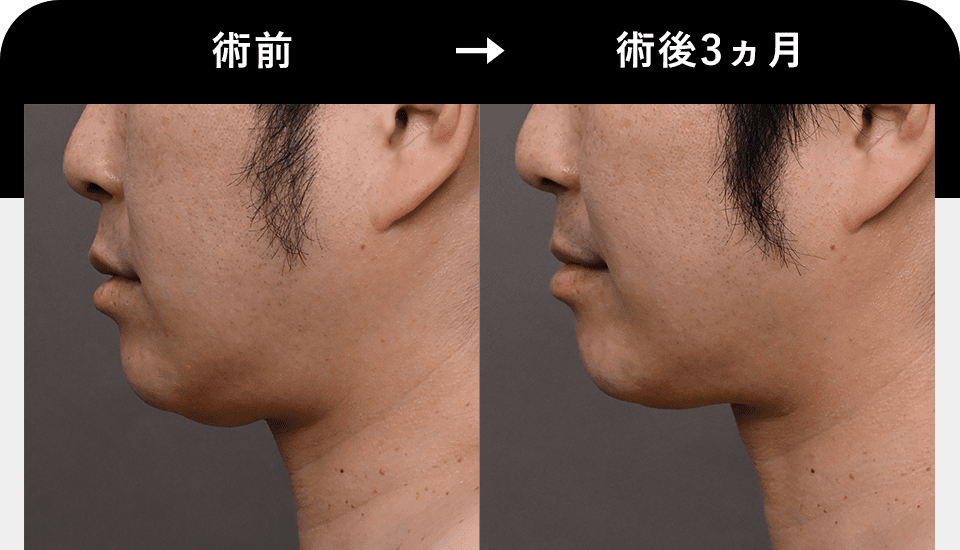 Before After