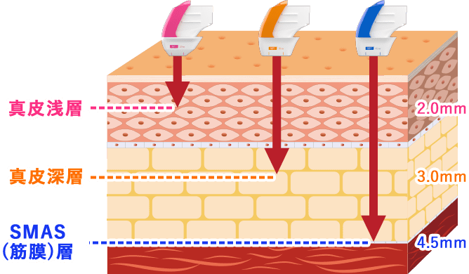 「ウルトラフォーマーMPT」のモードによる効果の違い イメージ