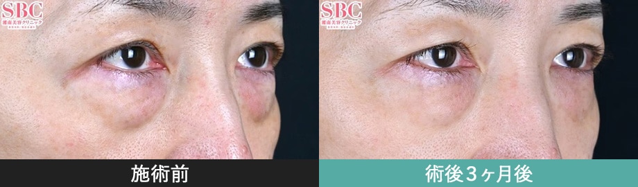 モフィウス8 症例写真 右斜め