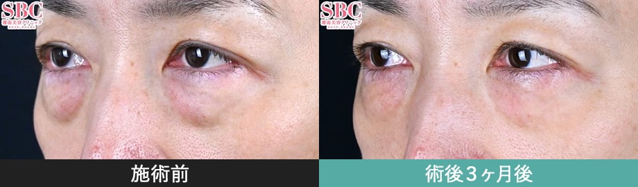 モフィウス8 症例写真 左斜め