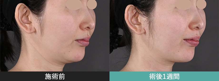 モフィウス8 症例写真 顔