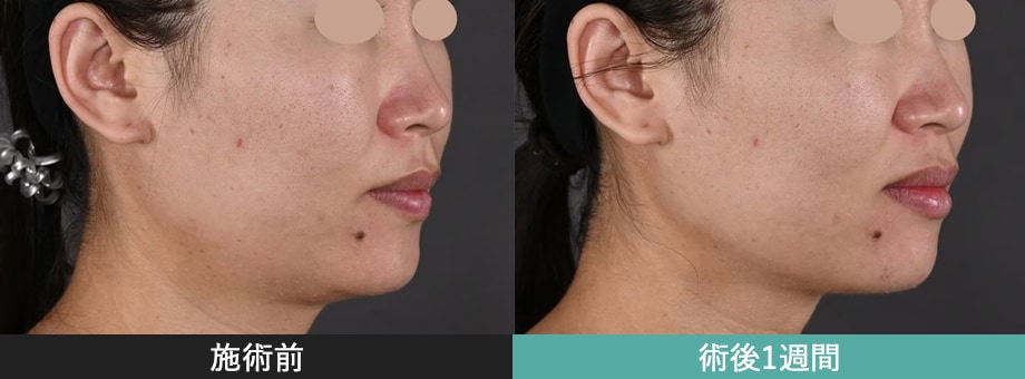 モフィウス8 症例写真 下顔面から首