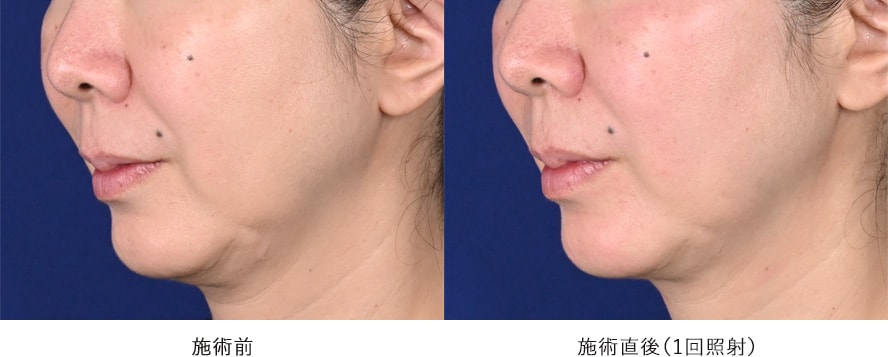 60代男性 / しわ、たるみのタイトニング 症例写真