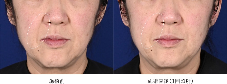 60代男性 / しわ、たるみのタイトニング 症例写真