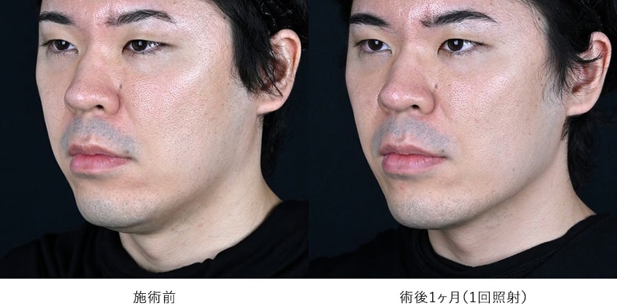 男性 / フェイスラインの引き締め 症例写真