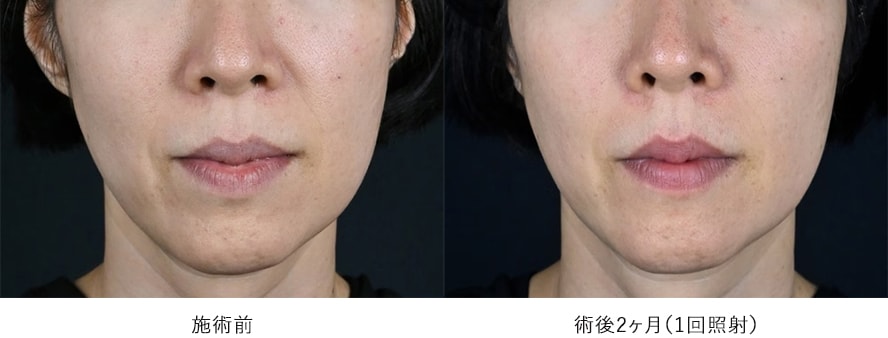 女性 / ほうれい線、マリオネットラインの改善