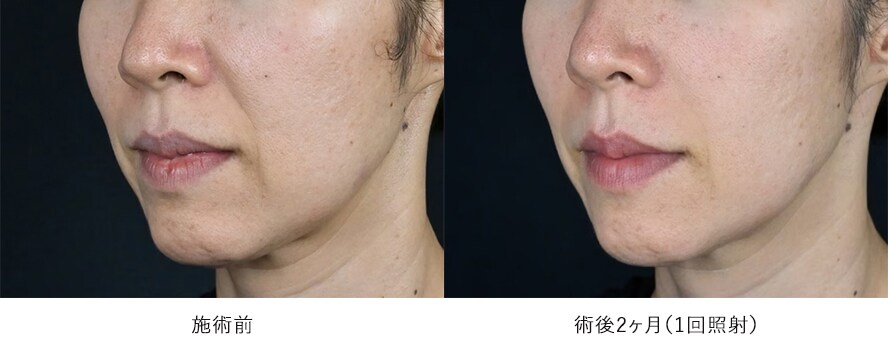 女性 / ほうれい線、マリオネットラインの改善