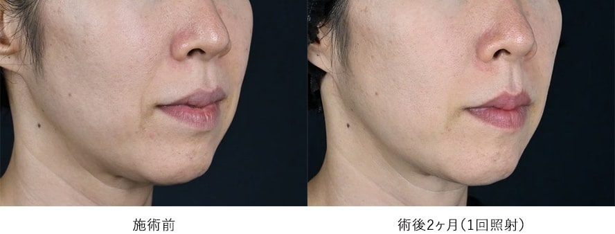 女性 / ほうれい線、マリオネットラインの改善