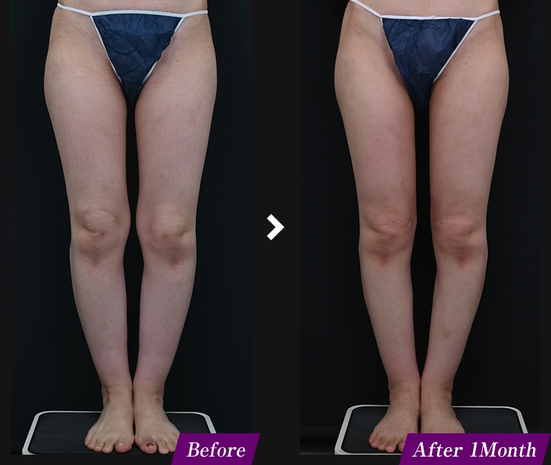 エンブレイスRF(フェイスタイト/ボディタイト) 腹部の症例写真 before after