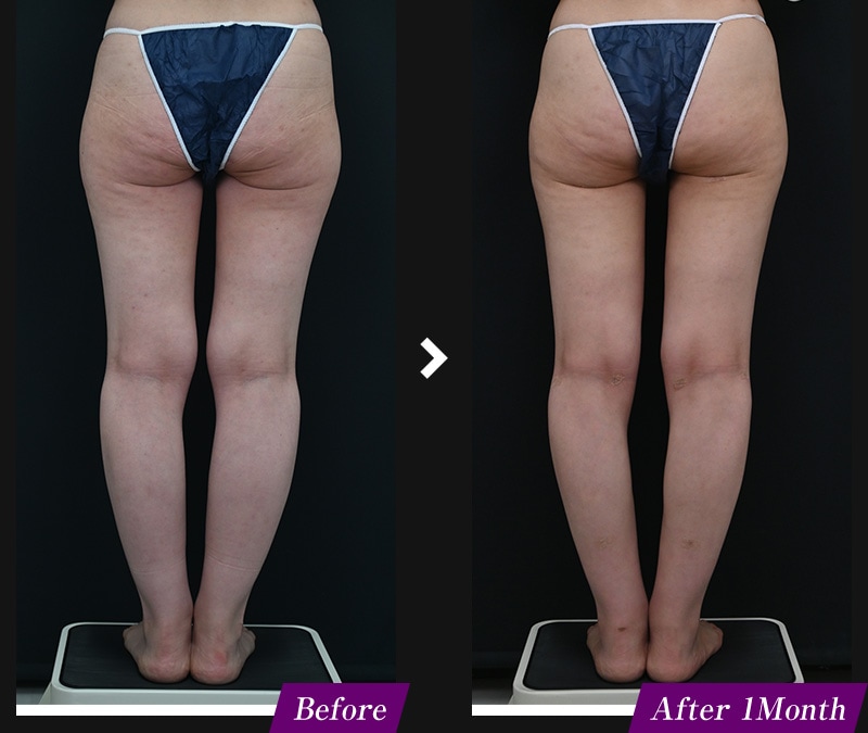 エンブレイスRF(フェイスタイト/ボディタイト) 腹部の症例写真 before after