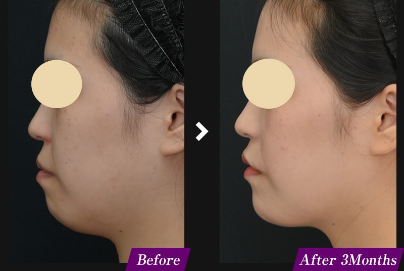 エンブレイスRF(フェイスタイト/ボディタイト) アゴ下の症例写真 before after