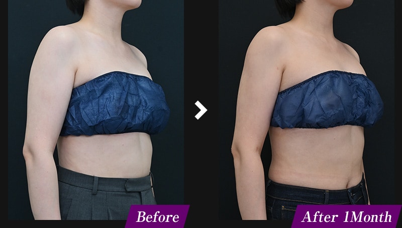 エンブレイスRF(フェイスタイト/ボディタイト) 二の腕の症例写真 before after