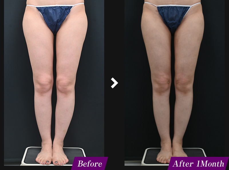 エンブレイスRF(フェイスタイト/ボディタイト) 太ももの症例写真 before after