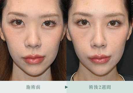 ヒアルロン酸症例 症例写真1