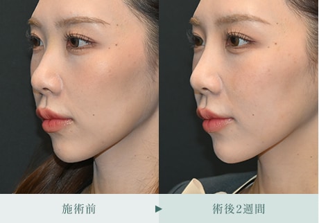 ヒアルロン酸症例 症例写真2