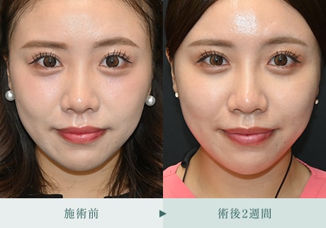 ヒアルロン酸症例 症例写真3