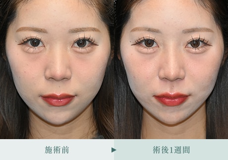 ヒアルロン酸症例 症例写真5