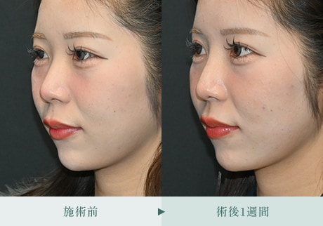 ヒアルロン酸症例 症例写真6