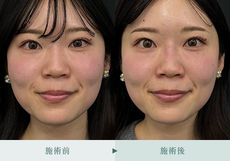 ヒアルロン酸症例 症例写真7