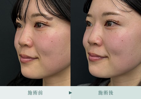 ヒアルロン酸症例 症例写真8