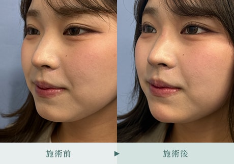 ヒアルロン酸症例 症例写真12