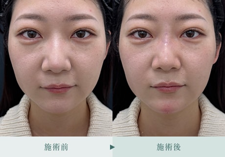 ヒアルロン酸症例 症例写真21