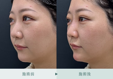 ヒアルロン酸症例 症例写真22