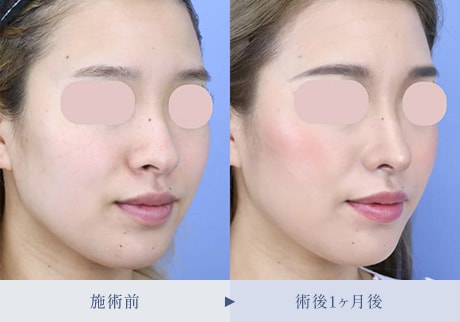 鼻整形症例 症例写真2