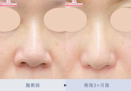 鼻整形症例 症例写真3