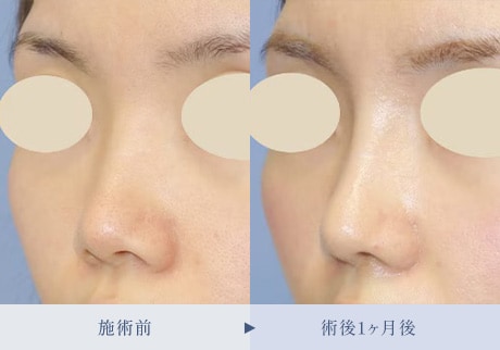 鼻整形症例 症例写真4