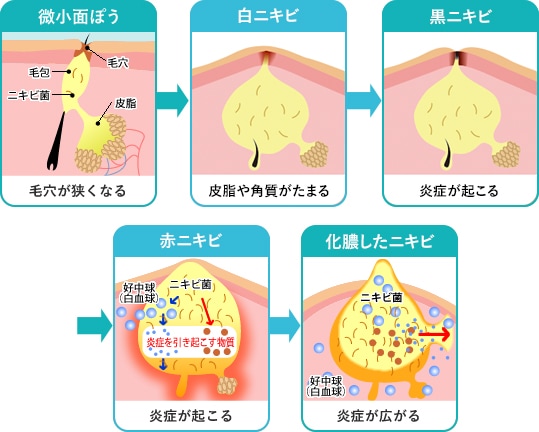 ニキビができるしくみと悪化する流れ イメージ3