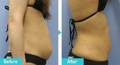 脂肪溶解注射 BNLS アルティメット(小顔注射) 症例写真 ビフォーアフター