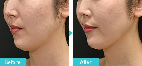 FatX Core 症例写真 ビフォーアフター