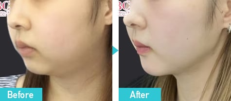 脂肪吸引注射 症例写真 ビフォーアフター