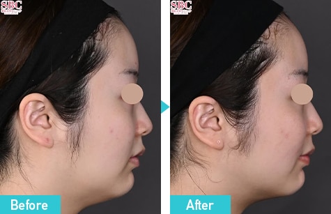 新・脂肪溶解リニアハイフ 症例写真 ビフォーアフター